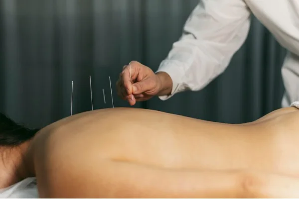 Acupuncture Thumbnail