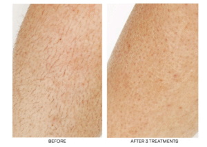 Before and after results of laser hair removal on arm – visible hair reduction after 3 sessions